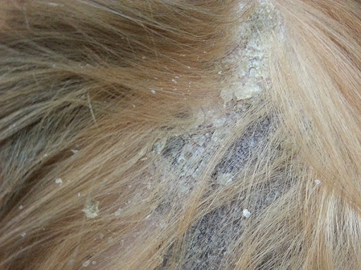 Vùng Lông Bị Rụng